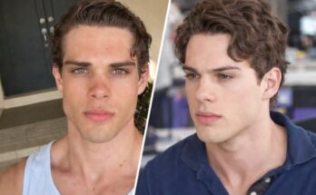 Clavicular Overdose Hospitalized